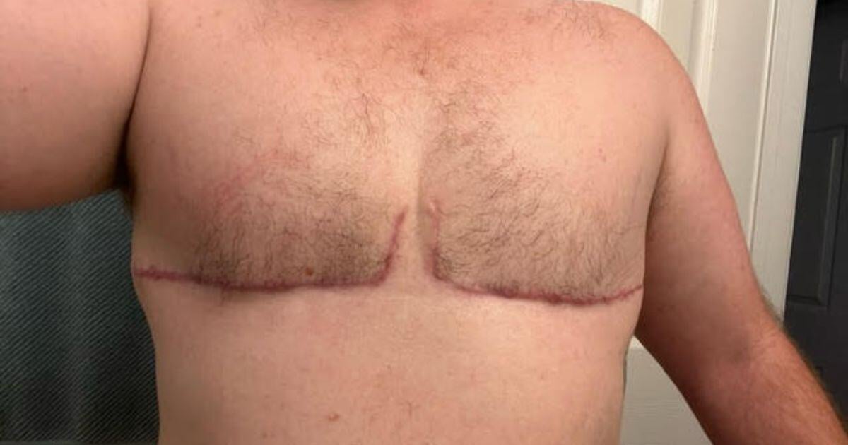 Close-up photo of post-surgery chest scars